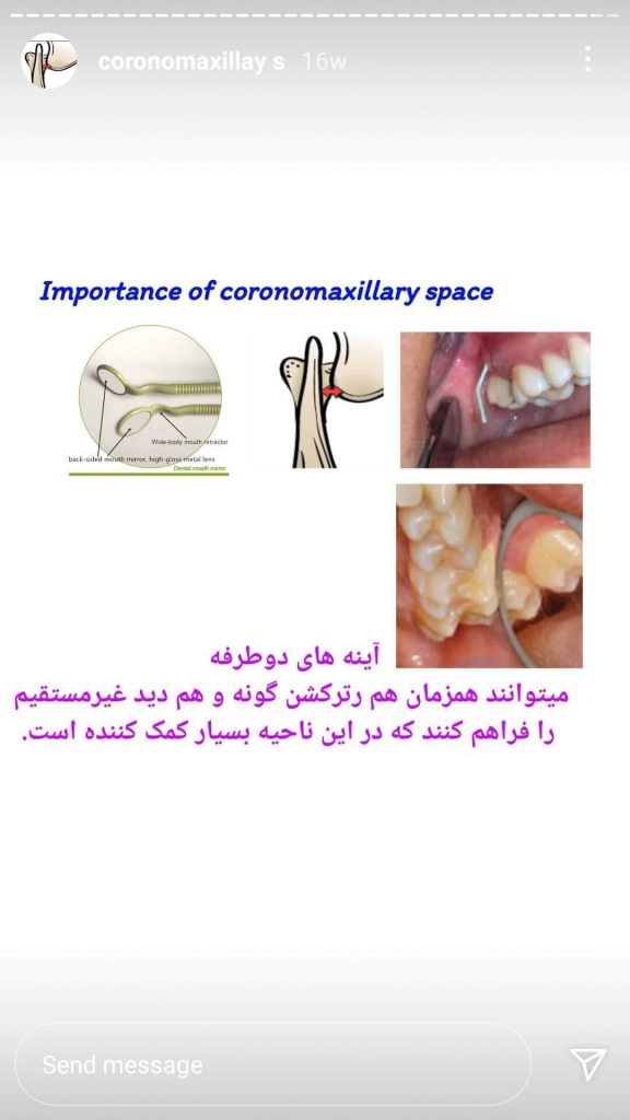 cornomaxillary space